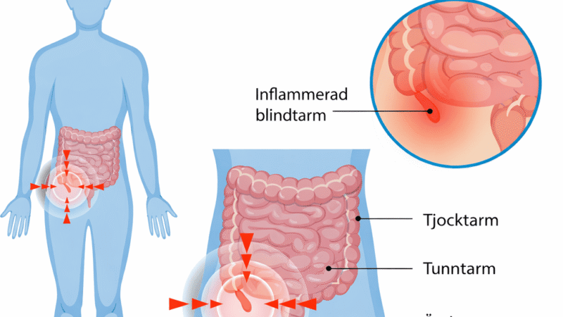 Blindtarm smärta kommer och går: symtom och vård