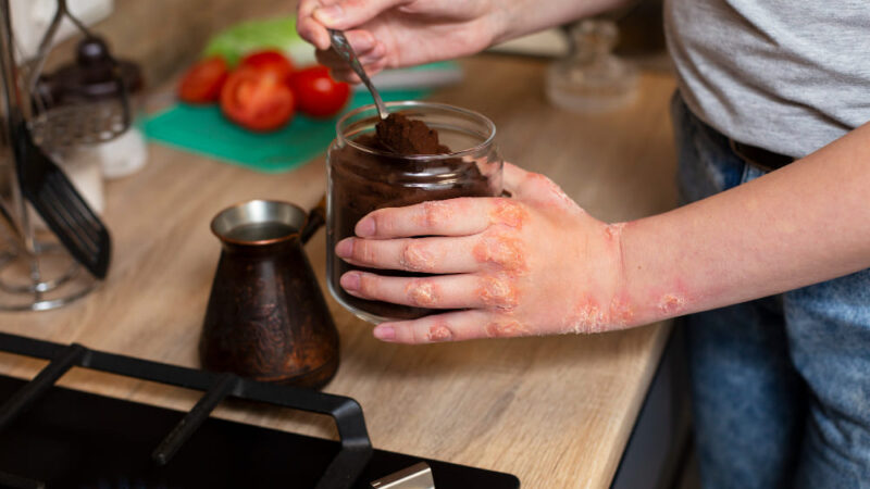 Brännskada huskur: bästa tips för snabb lindring hemma