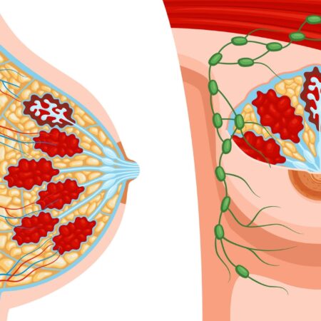 Fibroadenom i bröstet – symptom, orsaker och behandling