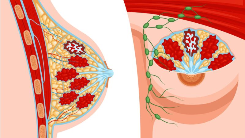 Fibroadenom i bröstet – symptom, orsaker och behandling